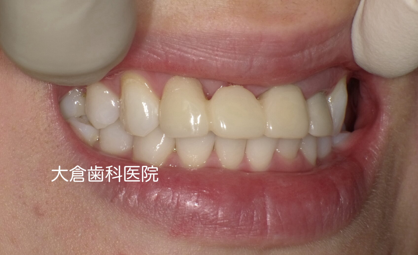 香芝　仮歯