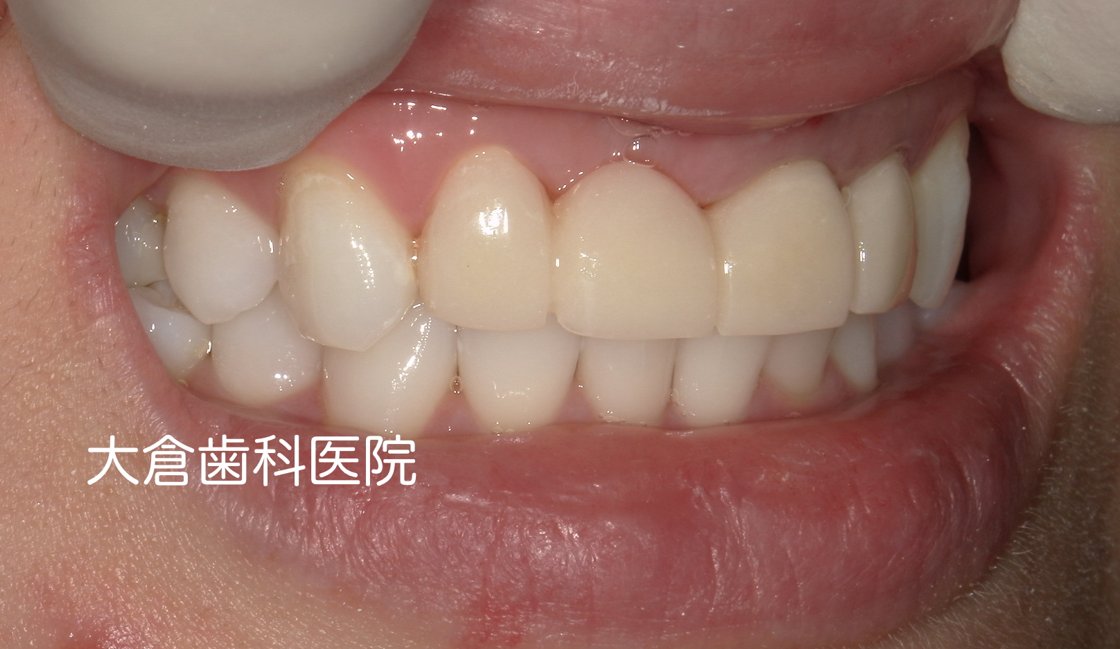 香芝　仮歯