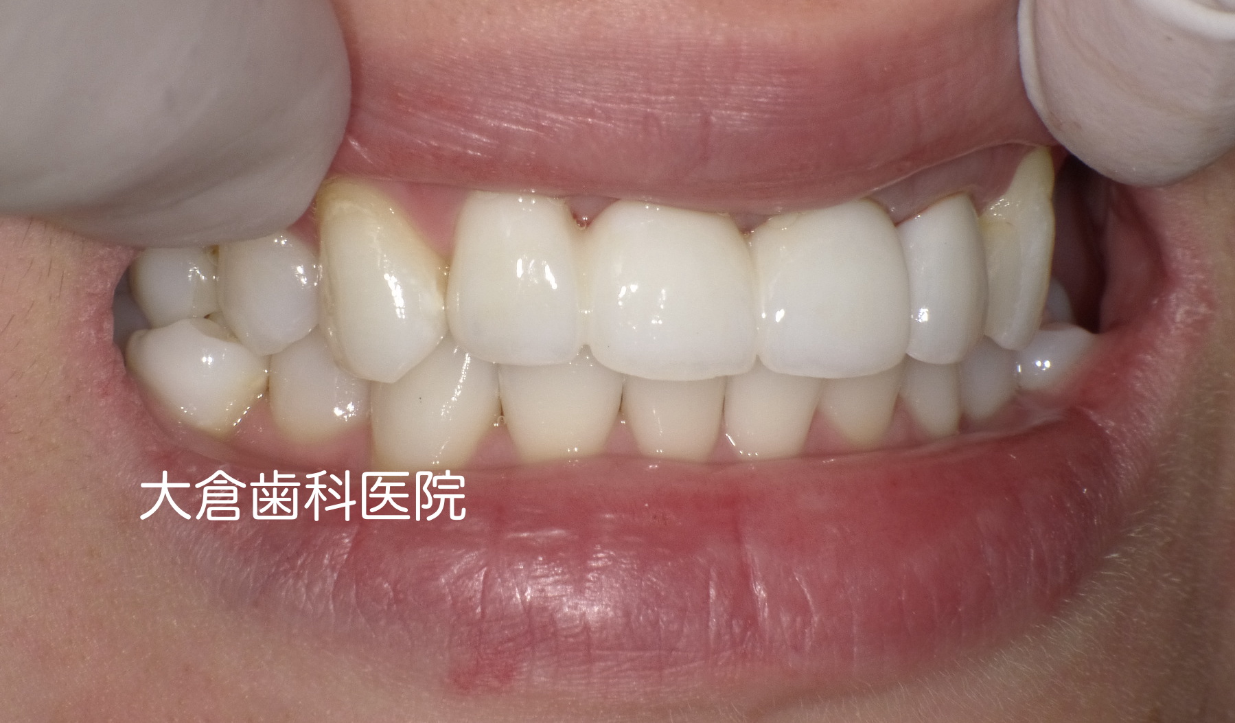 香芝 大倉歯科医院 セラミック