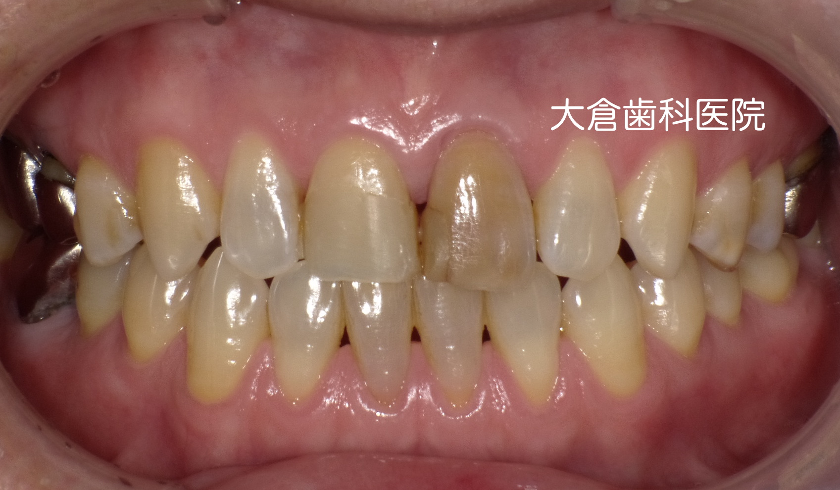 香芝　大倉歯科医院　セラミック