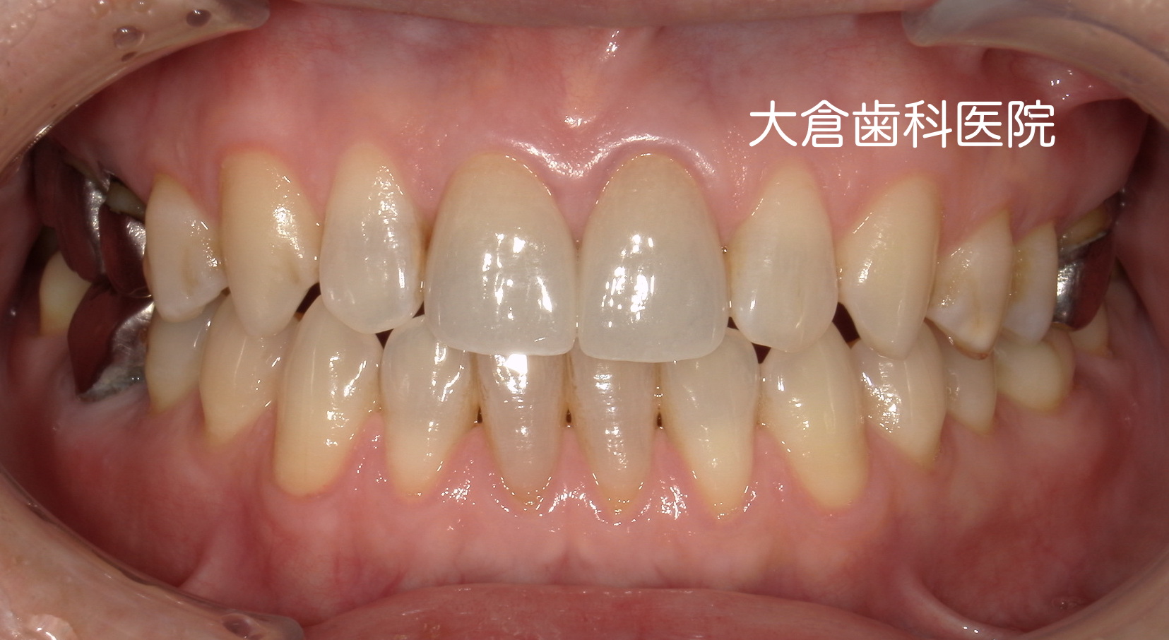香芝　大倉歯科医院　セラミック