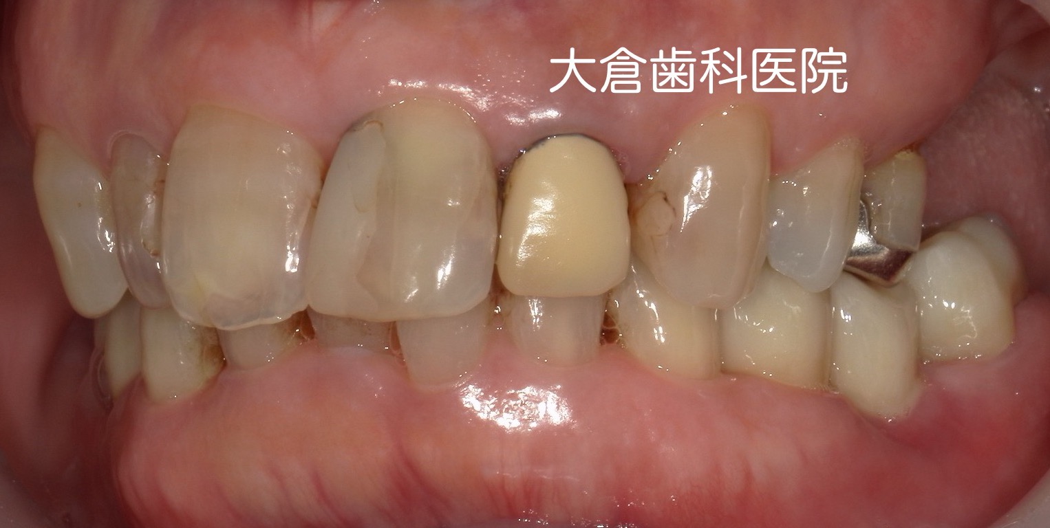 香芝　大倉歯科医院　セラミック
