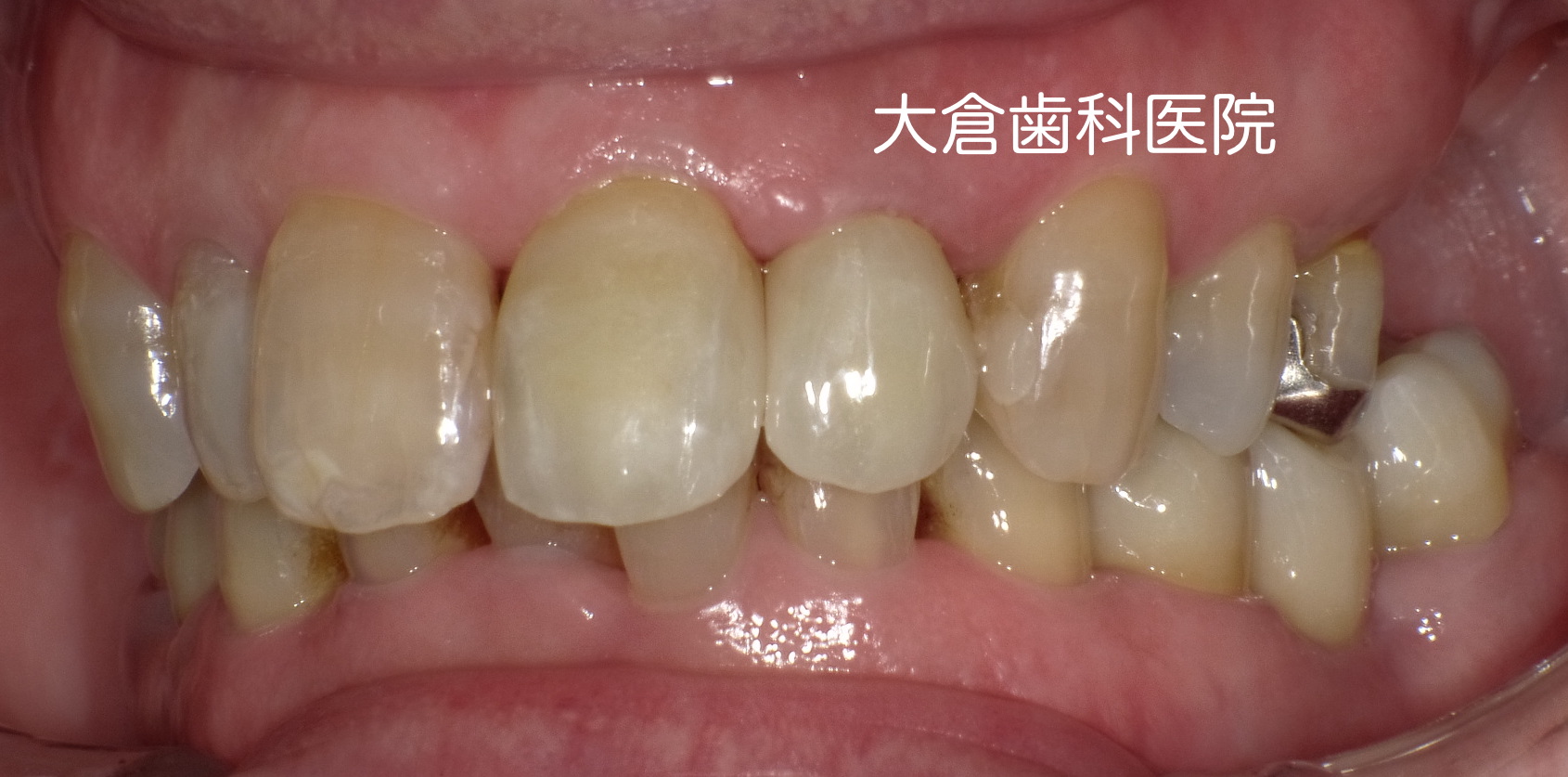 香芝　大倉歯科医院　セラミック