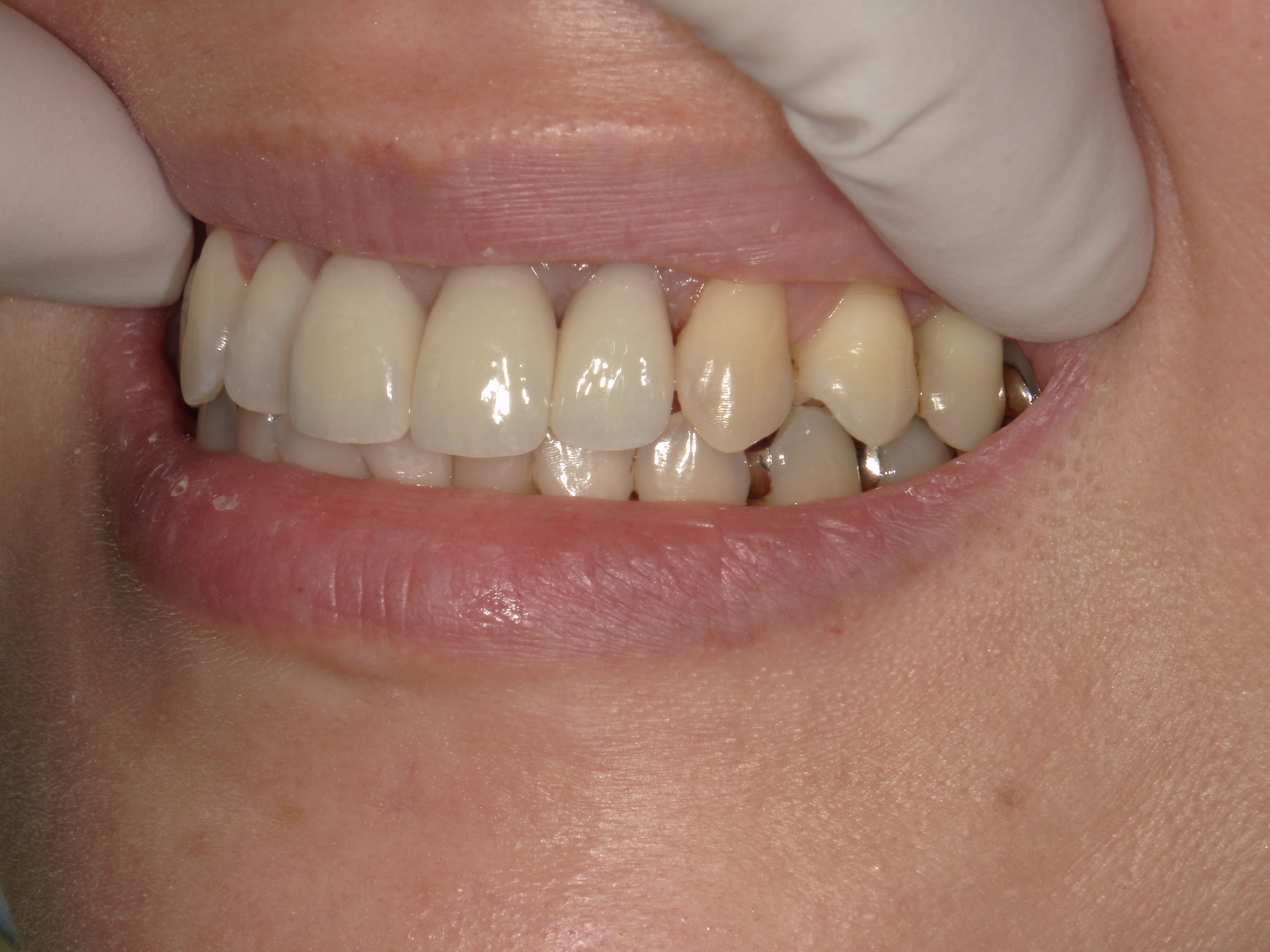 香芝　大倉歯科医院　セラミック